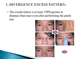 Exodeviations , Exotropia | PPTX