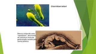 Clostridium tetani
Postura conhecida como
“opistótono”, decorrente
da contratura muscular
generalizada causada pela
toxina tetânica.
 