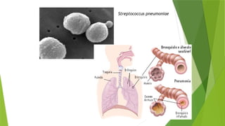 Streptococcus pneumoniae
 