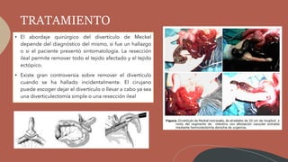 TRATAMIENTO
• El abordaje quirúrgico del divertículo de Meckel
depende del diagnóstico del mismo, si fue un hallazgo
o si el paciente presentó sintomatología. La resección
ileal permite remover todo el tejido afectado y el tejido
ectópico.
• Existe gran controversia sobre remover el divertículo
cuando se ha hallado incidentalmente. El cirujano
puede escoger dejar el divertículo o llevar a cabo ya sea
una diverticulectomía simple o una resección ileal
 