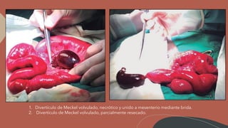 1. Divertículo de Meckel volvulado, necrótico y unido a mesenterio mediante brida.
2. Divertículo de Meckel volvulado, parcialmente resecado.
 