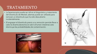 TRATAMIENTO
• La laparoscopía puede ser útil en el diagnóstico y tratamiento
del divertículo de Meckel, además puede ser utilizada para
remover un divertículo que ha sido descubierto
incidentalmente.
• El engrapar el divertículo previo a su remoción permite llevar a
cabo la diverticulectomía sin abrir el lumen intestinal, esto
disminuye las probabilidades de contaminación.
 