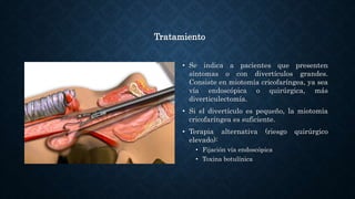 Tratamiento
• Se indica a pacientes que presenten
síntomas o con divertículos grandes.
Consiste en miotomía cricofaríngea, ya sea
vía endoscópica o quirúrgica, más
diverticulectomía.
• Si el divertículo es pequeño, la miotomía
cricofaríngea es suficiente.
• Terapia alternativa (riesgo quirúrgico
elevado):
• Fijación vía endoscópica
• Toxina botulínica
 