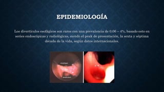 EPIDEMIOLOGÍA
Los divertículos esofágicos son raros con una prevalencia de 0.06 – 4%, basado esto en
series endoscópicas y radiológicas, siendo el peak de presentación, la sexta y séptima
década de la vida, según datos internacionales.
 