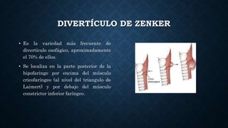 DIVERTÍCULO DE ZENKER
• Es la variedad más frecuente de
divertículo esofágico, aproximadamente
el 70% de ellos.
• Se localiza en la parte posterior de la
hipofaringe por encima del músculo
cricofaríngeo (al nivel del triangulo de
Laimert) y por debajo del músculo
constrictor inferior faríngeo.
 