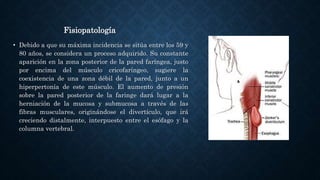 Fisiopatología
• Debido a que su máxima incidencia se sitúa entre los 59 y
80 años, se considera un proceso adquirido. Su constante
aparición en la zona posterior de la pared faríngea, justo
por encima del músculo cricofaríngeo, sugiere la
coexistencia de una zona débil de la pared, junto a un
hiperpertonía de este músculo. El aumento de presión
sobre la pared posterior de la faringe dará lugar a la
herniación de la mucosa y submucosa a través de las
fibras musculares, originándose el divertículo, que irá
creciendo distalmente, interpuesto entre el esófago y la
columna vertebral.
 