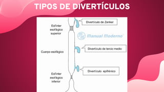 TIPOS DE DIVERTÍCULOS
 