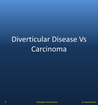 Dr. Naveed AshrafRadiologic Pictorial Review
Diverticular Disease Vs
Carcinoma
1
 