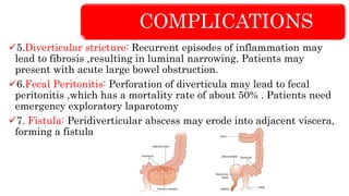 COMPLICATIONS
5.Diverticular stricture: Recurrent episodes of inflammation may
lead to fibrosis ,resulting in luminal narrowing. Patients may
present with acute large bowel obstruction.
6.Fecal Peritonitis: Perforation of diverticula may lead to fecal
peritonitis ,which has a mortality rate of about 50% . Patients need
emergency exploratory laparotomy
7. Fistula: Peridiverticular abscess may erode into adjacent viscera,
forming a fistula
 