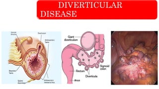 DIVERTICULAR
DISEASE
 