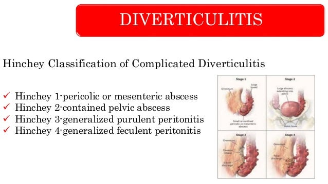 HINCHEY DIVERTICULITIS EBOOK DOWNLOAD HINCHEY DIVERTICULITIS EBOOK DOWNLOAD