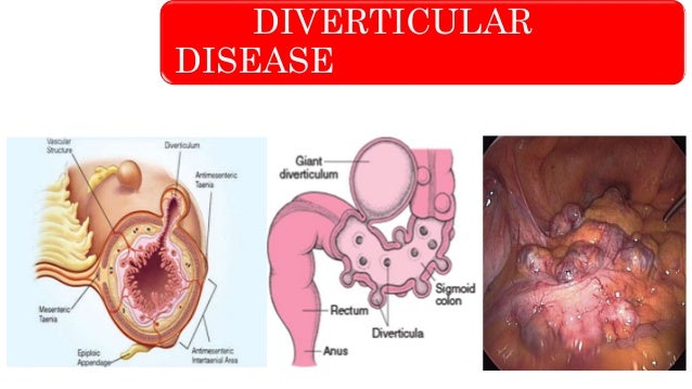 baby high food fiber in Hemorrhage Diverticular Lower GI Disease baby high food fiber in Hemorrhage Diverticular Lower GI Disease