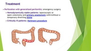 Treatment
• Perforation with generalized peritonitis: emergency surgery
• Hemodynamically stable patients: laparoscopic or
open colectomy and primary anastomosis with/without a
temporary diverting stoma
• Critically ill patients: Hartmann procedure
 