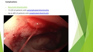 Complications
• Recurrent diverticulitis
• 13–23% of patients with uncomplicated diverticulitis
• Up to 40% of patients with complicated diverticulitis
 