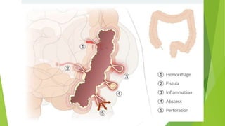 diverticular disease [تم حفظه تلقائيا] 3.pptx