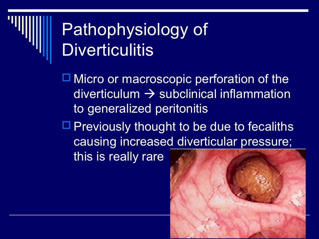 Diverticular disease of colon