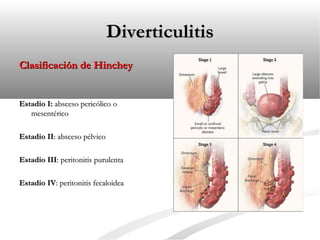 Diverticulitis
Clasificación de Hinchey

Estadio I: absceso pericólico o
mesentérico
Estadio II: absceso pélvico
Estadio III: peritonitis purulenta
Estadio IV: peritonitis fecaloidea

 