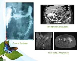 Enema Baritado
Tomografía Computada
Resonancia Magnética
 