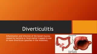 Diverticulitis
Inflammation and infection of the bowel mucosa
caused by bacteria or fecal matter trapped in one
or more diverticula (pouches in the intestine).
 