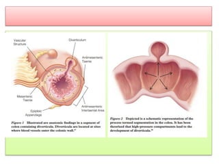 Diverticulitis | PPTX