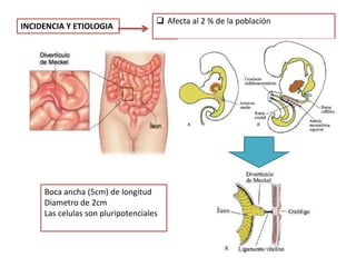 INCIDENCIA Y ETIOLOGIA
 Afecta al 2 % de la población
Boca ancha (5cm) de longitud
Diametro de 2cm
Las celulas son pluripotenciales
 