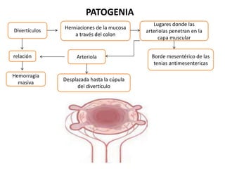 PATOGENIA
Divertículos
Herniaciones de la mucosa
a través del colon
Lugares donde las
arteriolas penetran en la
capa muscular
Borde mesentérico de las
tenias antimesentericas
Arteriola
Desplazada hasta la cúpula
del divertículo
relación
Hemorragia
masiva
 
