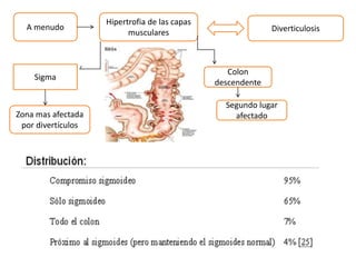 a A menudo
Hipertrofia de las capas
musculares Diverticulosis
Sigma
Zona mas afectada
por divertículos
Colon
descendente
Segundo lugar
afectado
 