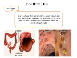 DIVERTICULITIS
Concepto
Es el resultado de la perforación de un divertículo del
colon que provoca una infección pericolica extraluminal
causada por la extravasación de heces a través del
divertículo perforado
 