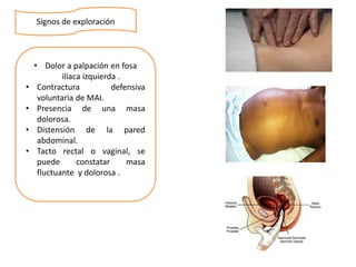 Signos de exploración
• Dolor a palpación en fosa
iliaca izquierda .
• Contractura defensiva
voluntaria de MAI.
• Presencia de una masa
dolorosa.
• Distensión de la pared
abdominal.
• Tacto rectal o vaginal, se
puede constatar masa
fluctuante y dolorosa .
 