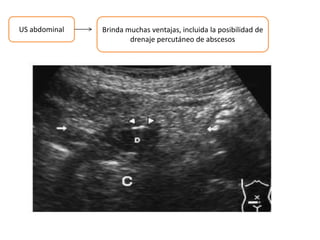 US abdominal Brinda muchas ventajas, incluida la posibilidad de
drenaje percutáneo de abscesos
 