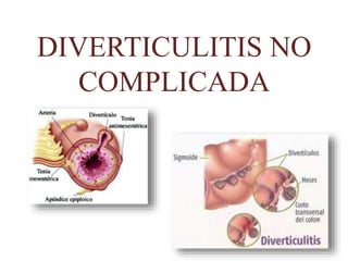 DIVERTICULITIS NO
COMPLICADA
 