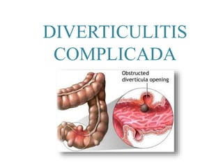 DIVERTICULITIS
COMPLICADA
 