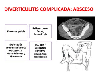 DIVERTICULITIS COMPLICADA: ABSCESO
Abscesos: pelvis
Refiere: dolor,
fiebre,
leucocitosis
Exploración
abdominal/gineco
lógica/rectal:
Masa dolorosa y
fluctuante
TC / RM /
Ecografía:
confirma
diagnóstico,
localización
 