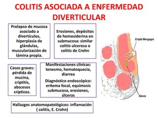 COLITIS ASOCIADA A ENFERMEDAD
DIVERTICULAR
Prolapso de mucosa
asociado a
divertículos,
hiperplasia de
glándulas,
muscularización de
lámina propia.
Erosiones, depósitos
de hemosiderina en
submucosa: similar
colitis ulcerosa o
colitis de Crohn
Casos graves:
pérdida de
mucina,
criptitis,
abscesos
crípticos.
Manifestaciones clínicas:
tenesmo, hematoquecia,
diarrea
Diagnóstico endoscópico:
eritema focal, equimosis
submucosa, erosiones,
úlceras
Hallazgos anatomopatológicos: inflamación
( colitis, E. Crohn)
 