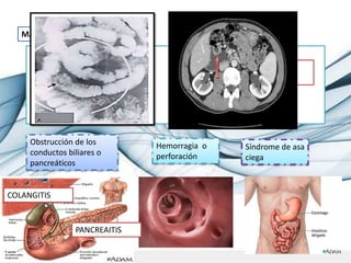 MANIFESTACIONES CLINICAS
- Son asintomáticos
- Se descubren de manera casual
Endoscopia
Radiografía simple de abdomen
TC
Las complicaciones mayores:
Obstrucción de los
conductos biliares o
pancreáticos
Hemorragia o
perforación
Síndrome de asa
ciega
Molestias epigástricas
inespecíficas
COLANGITIS
PANCREAITIS
 