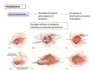 TRATAMIENTO
Diverticulectomía Maniobra de kocher
para exponer el
duodeno
Se extirpa el
diverticulo y se cierra
el duodeno
Se debe verificar el conducto
colédoco y conducto pancreático
 