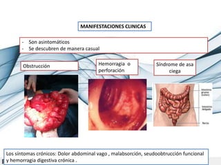 MANIFESTACIONES CLINICAS
- Son asintomáticos
- Se descubren de manera casual
Obstrucción Hemorragia o
perforación
Síndrome de asa
ciega
Los síntomas crónicos: Dolor abdominal vago , malabsorción, seudoobtrucción funcional
y hemorragia digestiva crónica .
 