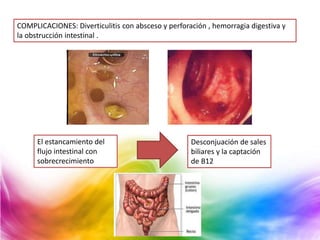 COMPLICACIONES: Diverticulitis con absceso y perforación , hemorragia digestiva y
la obstrucción intestinal .
El estancamiento del
flujo intestinal con
sobrecrecimiento
Desconjuación de sales
biliares y la captación
de B12
 