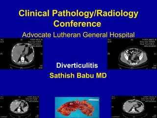 Clinical Pathology/Radiology
Conference
Advocate Lutheran General Hospital
Diverticulitis
Sathish Babu MD
 