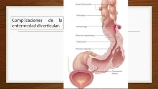 Complicaciones de la
enfermedad diverticular.
 