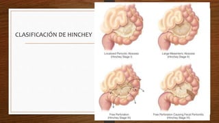 CLASIFICACIÓN DE HINCHEY
 