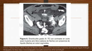 Octavio Valencia Huerta (2016) Estadio de Hinchey más frecuentemente encontrado en pacientes del Hospital Ángeles Pedregal.
Medigraphic. En línea: http://www.medigraphic.com/pdfs/actmed/am-2016/am162b.pdf
 
