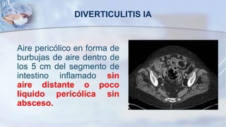 Aire pericólico en forma de
burbujas de aire dentro de
los 5 cm del segmento de
intestino inflamado sin
aire distante o poco
líquido pericólica sin
absceso.
DIVERTICULITIS IA
 