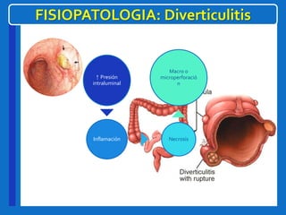 +
FISIOPATOLOGIA: Diverticulitis
↑ Presión
intraluminal
Inflamación Necrosis
Macro o
microperforació
n
 