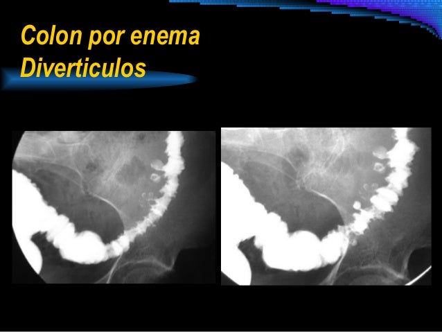 Resultado de imagen para colon por enema diverticulos