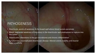 Diverticulitis Journal Club Presentation | PPTX