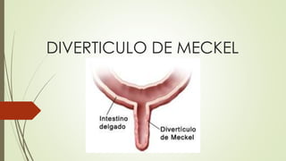 DIVERTICULO DE MECKEL 
 