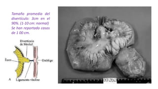 Tamaño promedio del
divertículo: 3cm en el
90%. (1-10 cm: normal)
Se han reportado casos
de 1 00 cm.
 