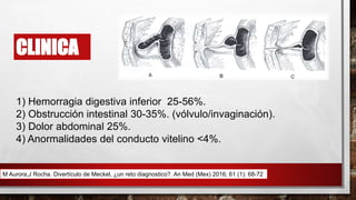 CLINICA
1) Hemorragia digestiva inferior 25-56%.
2) Obstrucción intestinal 30-35%. (vólvulo/invaginación).
3) Dolor abdominal 25%.
4) Anormalidades del conducto vitelino <4%.
M Aurora,J Rocha. Divertículo de Meckel, ¿un reto diagnostico?. An Med (Mex) 2016; 61 (1): 68-72
 