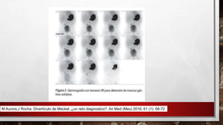 M Aurora,J Rocha. Divertículo de Meckel, ¿un reto diagnostico?. An Med (Mex) 2016; 61 (1): 68-72
 